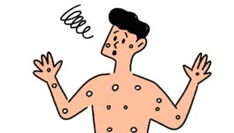 サル痘（エムポックス）感染者　タイ国内で約1000人 - ワイズデジタル【タイで生活する人のための情報サイト】